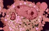 Nuova Terapia per il cancro del fegato